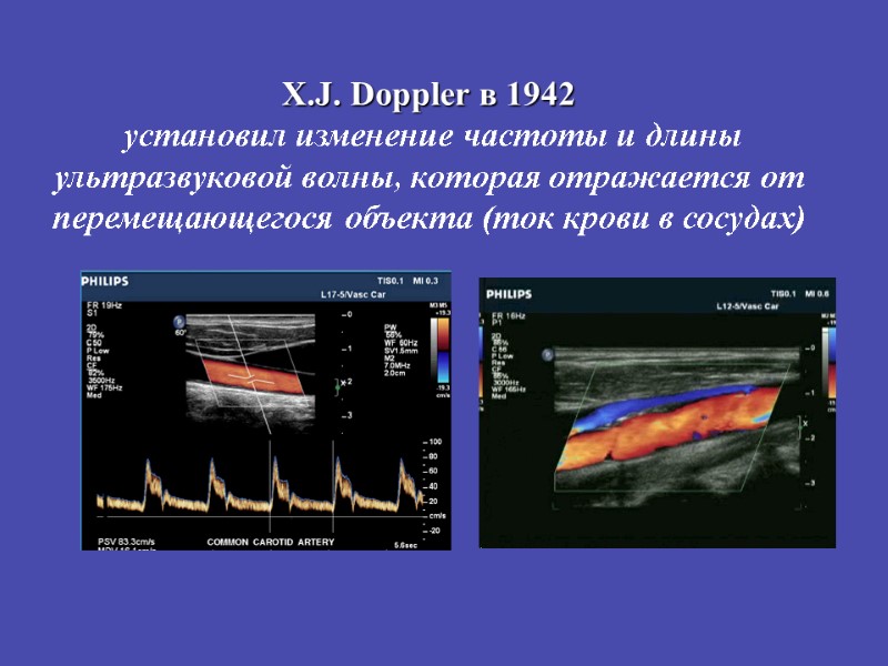 X.J. Doppler в 1942  установил изменение частоты и длины  ультразвуковой волны, которая